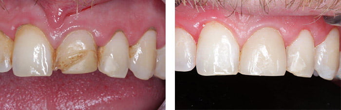 Porcelain veneer treatment
