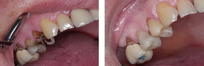 Broken and decayed teeth replaced with composite filling
