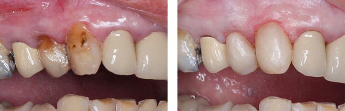 Abrasion cavities treated with composite fillings
